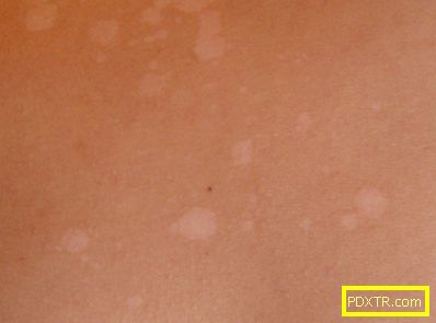Бяло петна по кожата след слънчево изгаряне, фото